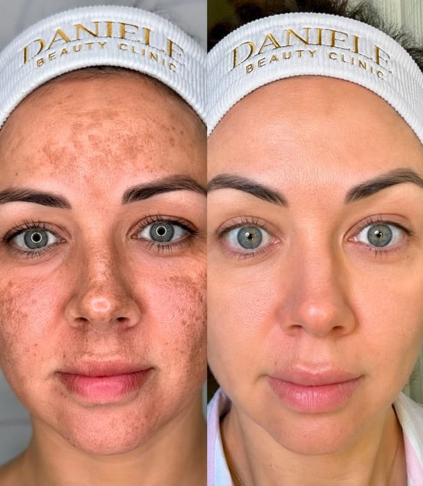Antes e depois de peeling: clareamento de manchas no rosto