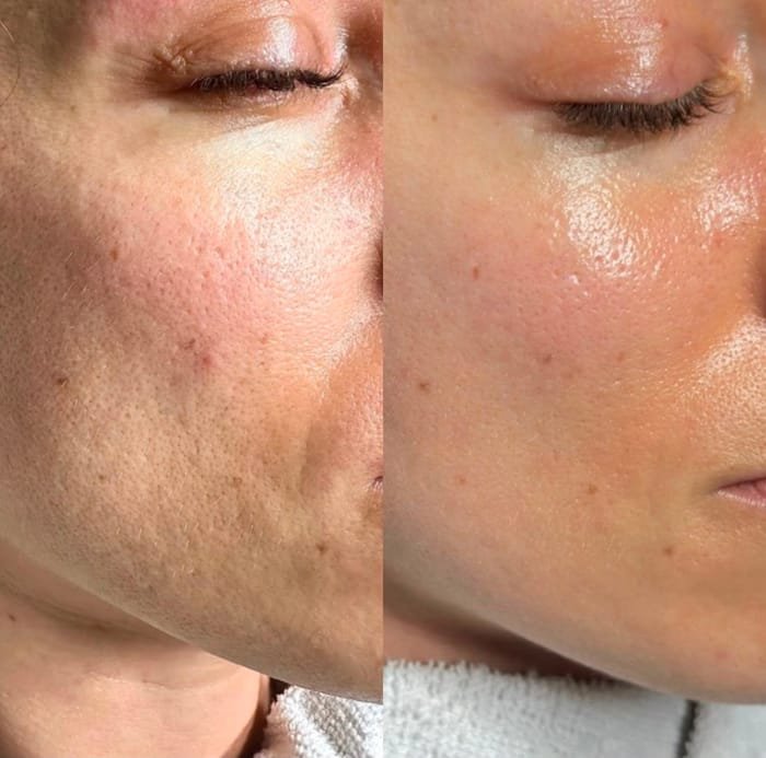 Antes e depois de microagulhamento: melhora de textura